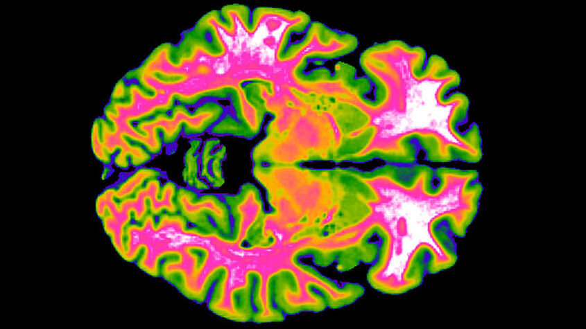 This structural MRI image is an example of how activity of specific brain networks can be visualized using fMRI. The colors show the different structures of the brain.
