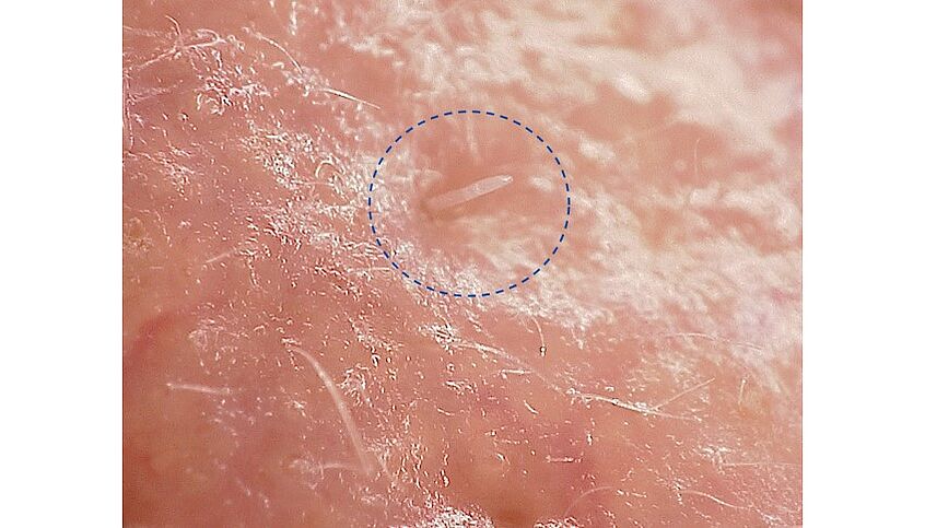Mikroskopische Aufnahme einer in einer Hautpore steckenden Demodex folliculorum-Milbe (© Alejandra Perotti) Mikroskopische Aufnahme einer in einer Hautpore steckenden Demodex folliculorum-Milbe
